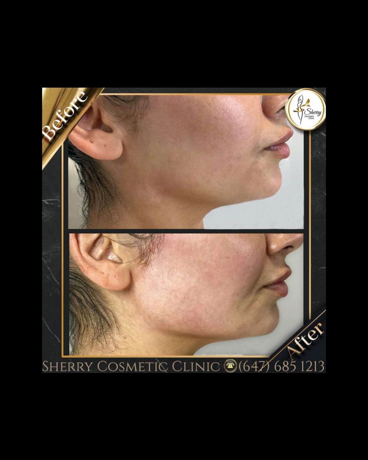 Youthful Skin with Botox in Sherry Cosmetics
