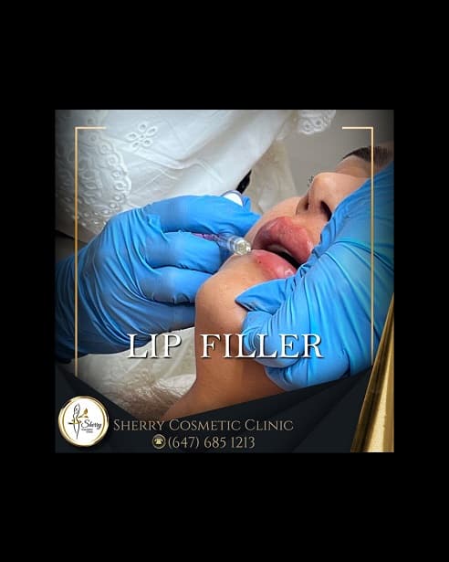 Transform Your Smile with Lip Fillers at Sherry Cosmetic